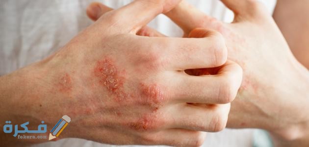 احدث طرق علاج مرض الصدفية بالاعشاب تشبه الصدفية