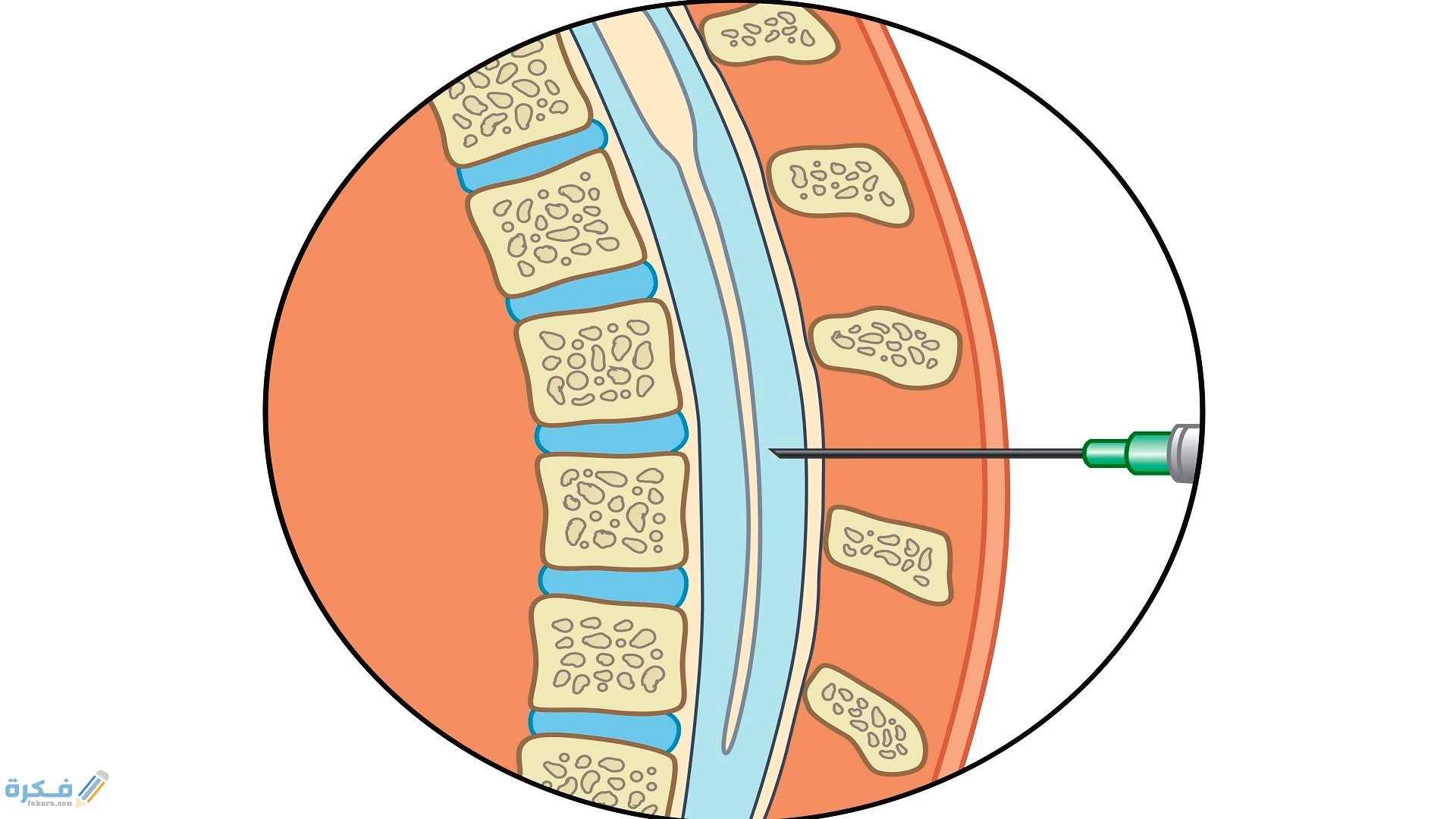 تكلفة عملية البزل للمفاصل في مصر 3 أنواع عمليات البزل