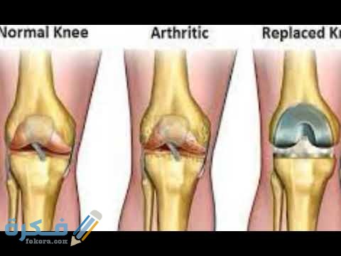 كم تكلفة عملية غضروف الركبة بالمنظار في مصر 2 تكلفة عملية غضروف الركبة بالمنظار في مصر