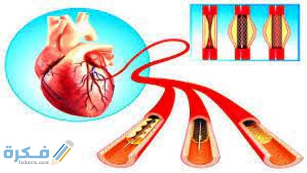 مفهوم قسطرة القلب