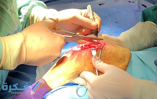 كم تكلفة عملية الرباط الصليبي 3 تكاليف عملية الرباط الصليبي