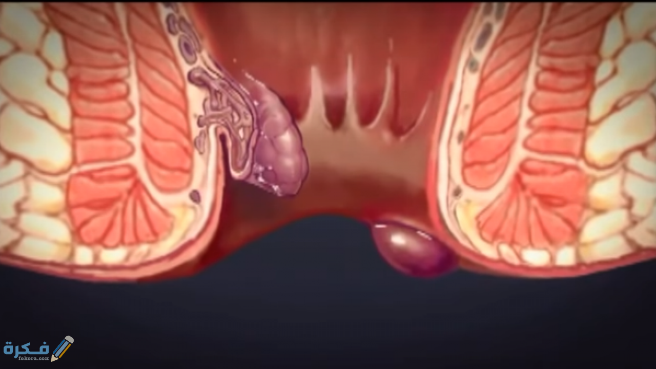 تكلفة عملية البواسير 4 إجراءات ما بعد عملية البواسير