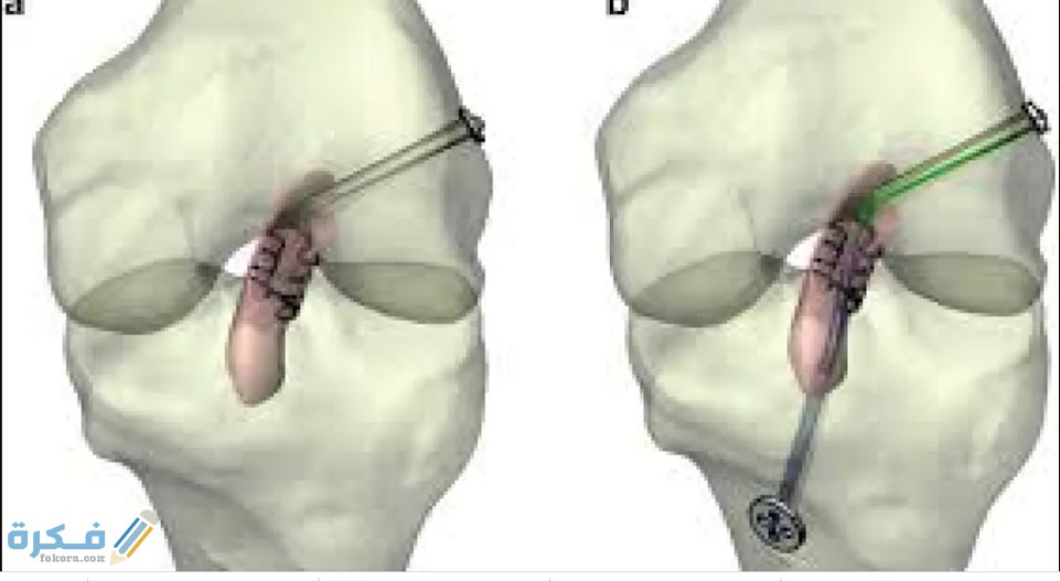 كم تكلفة عملية الرباط الصليبي 2 تكلفة عملية الرباط الصليبي