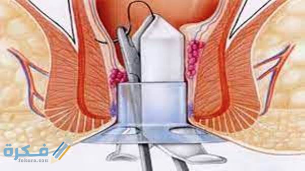 تكلفة عملية البواسير 2 تكلفة عملية البواسير