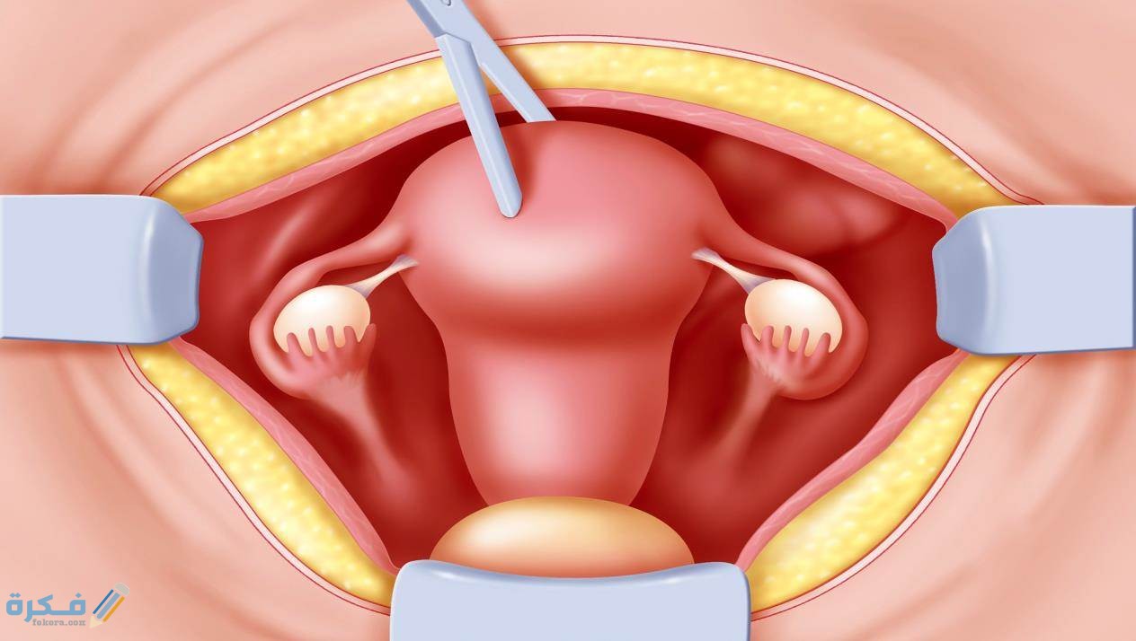 تكلفة عملية استئصال الرحم 3 أنواع عمليات استئصال الرحم
