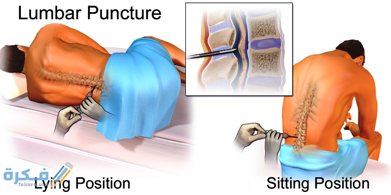 تكلفة عملية البزل للمفاصل في مصر 4 تكاليف عمليات البزل في مصر