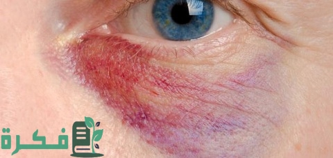 اسم احسن مرهم لعلاج الكدمات حول العين