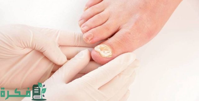 ما سبب اصفرار أظافر القدمين ما سبب اصفرار أظافر القدمين