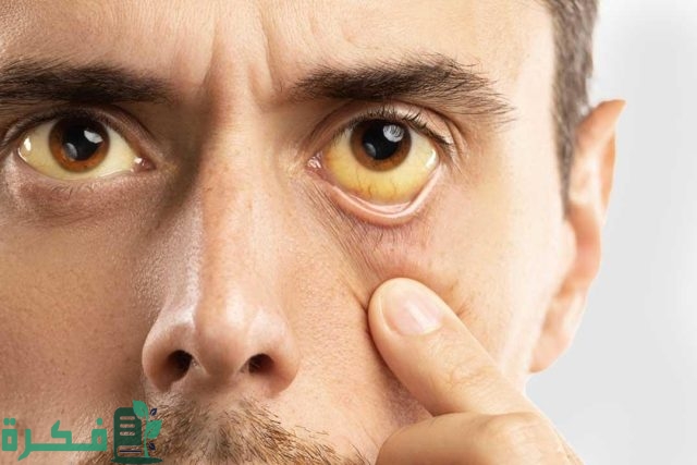 ما سبب اصفرار في العينين ما سبب اصفرار في العينين