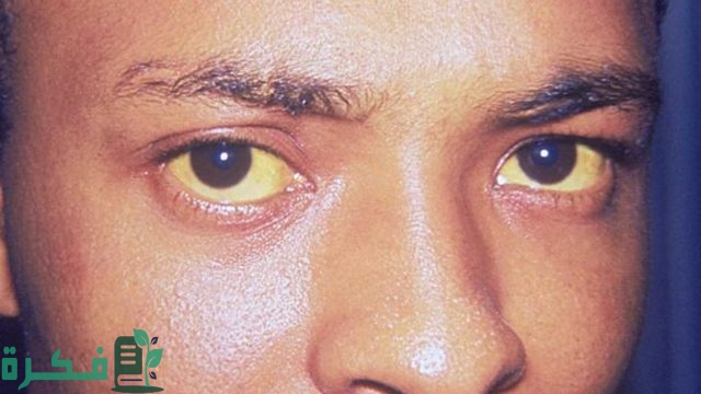 ما سبب اصفرار في العينين ما سبب اصفرار في العينين