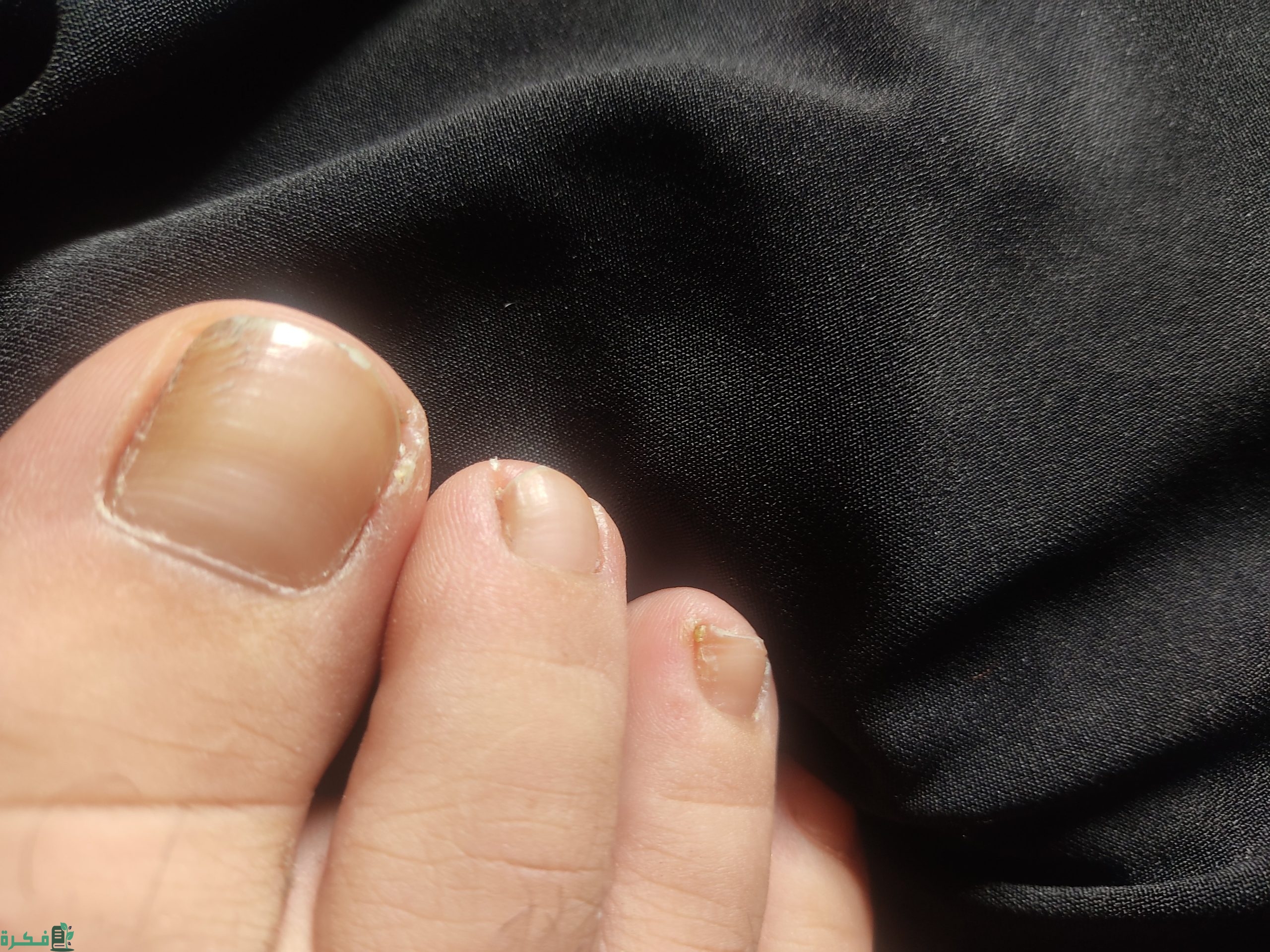ما سبب اصفرار أظافر القدمين