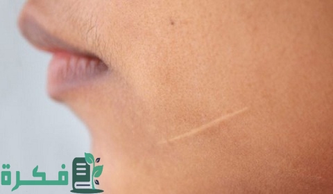 ما هو احسن كريم لإزالة آثار الخياطة في الوجه للأطفال