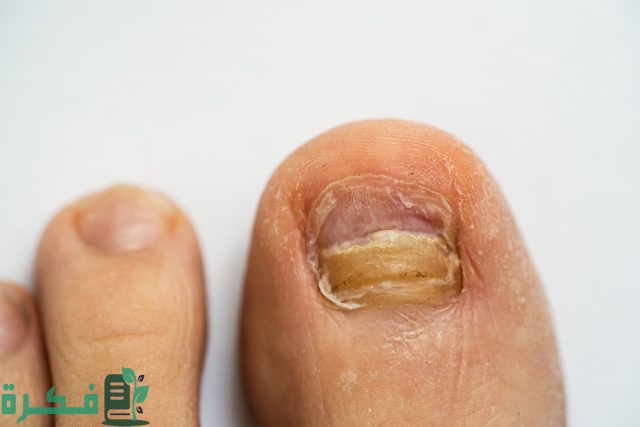 ما سبب اصفرار أظافر القدمين ما سبب اصفرار أظافر القدمين