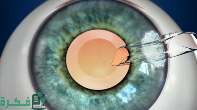 هل يمكن إزالة العدسة المزروعة في العين هل يمكن إزالة العدسة المزروعة في العين