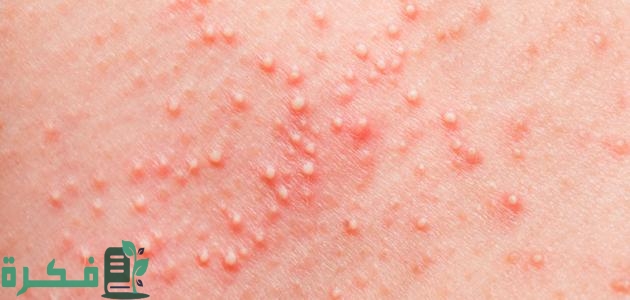 الحبوب الجلدية