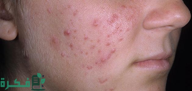 دواء حب الشباب من الصيدلية دواء حب الشباب من الصيدلية