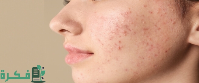 اسم دواء حب الشباب من الصيدلية