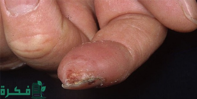 أفضل 5 أنواع مرهم لعلاج التثليج