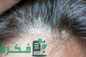 طرق علاج اكزيما الشعر 12 سبب لاكزيما الشعر 2 طرق علاج اكزيما الشعر