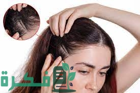 طرق علاج اكزيما الشعر 12 سبب لاكزيما الشعر 3 طرق علاج اكزيما الشعر