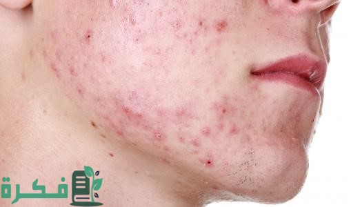 أسماء احسن 5 أدوية علاج حب الشباب للبشرة الدهنية