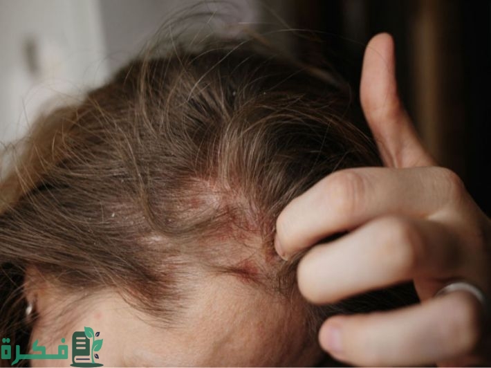 طرق علاج اكزيما الشعر 12 سبب لاكزيما الشعر