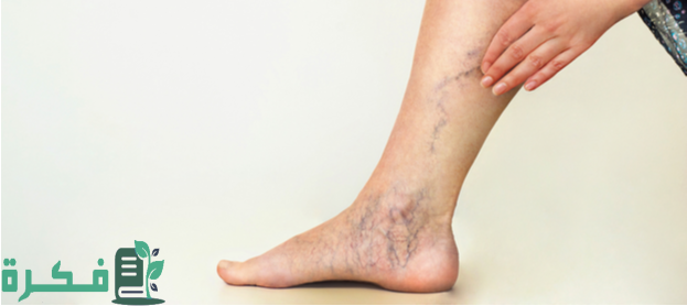 أسماء احسن 5 أنواع كريم لعلاج دوالي الساقين