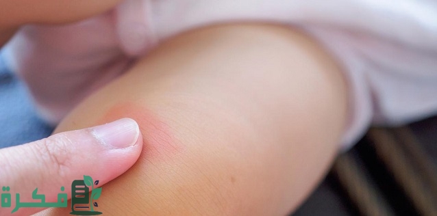أسماء احسن 5 أنواع كريم لعلاج قرص الناموس للرضع
