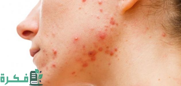 ظهور حبوب في الجسم أثناء الحمل وجنس الجنين ظهور حبوب في الجسم أثناء الحمل وجنس الجنين