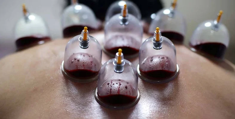 هل الحجامة مفيدة لمريض فقر الدم؟ هل الحجامة مفيدة لمريض فقر الدم؟